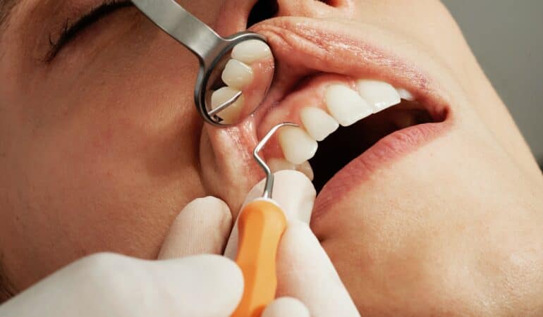 détartrage dentaire
